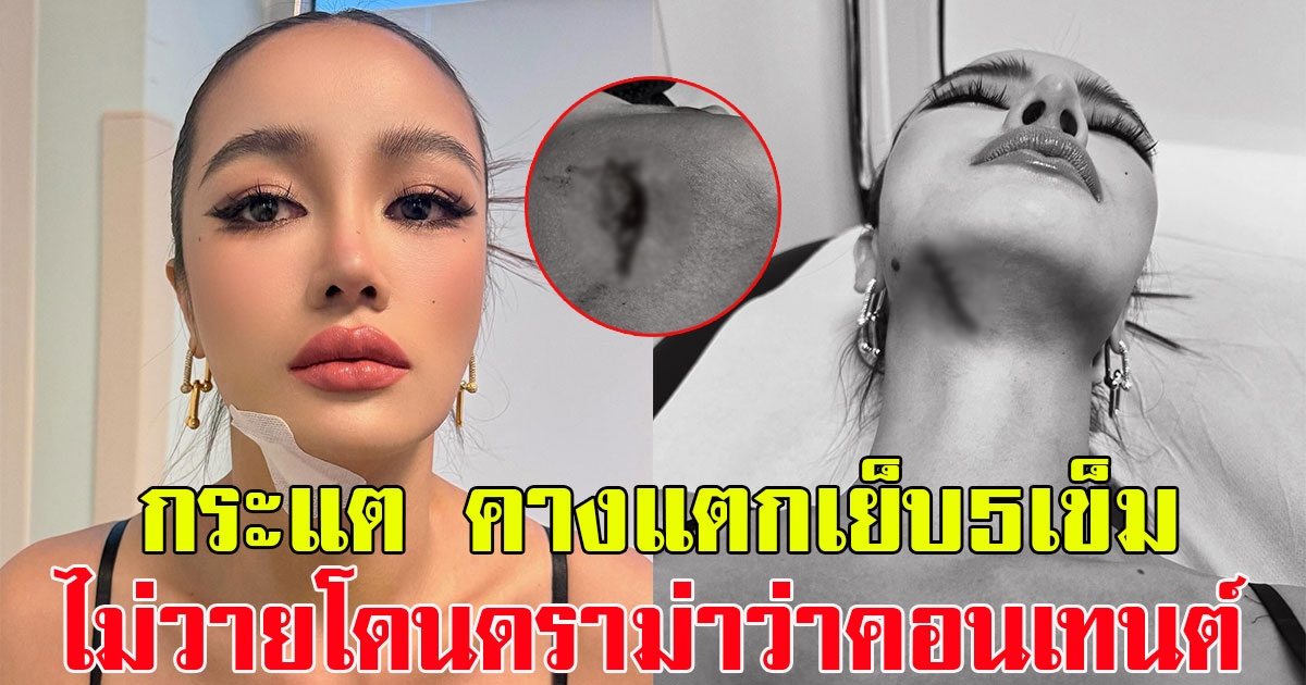 กระแต อาร์สยาม เกิดอุบัติเหตุหนัก คางแตกเย็บ5เข็ม ไม่วายโดนดราม่าว่าคอนเทนต์