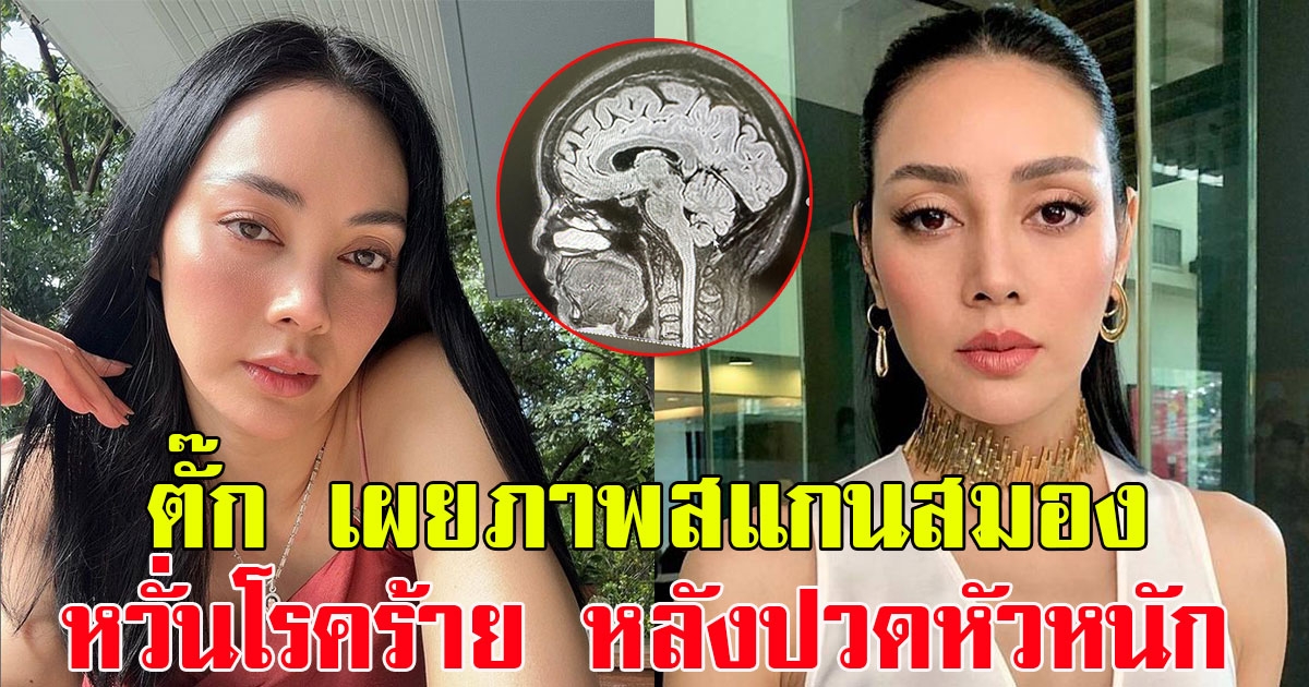 แฟนๆแห่ส่งกำลังใจ ตั๊ก บงกช เผยภาพสแกนสมอง หวั่นโรคร้าย หลังปวดหัวหนักมาก