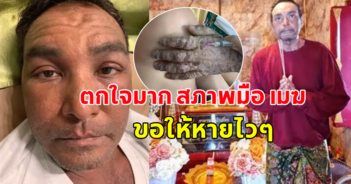 ตกใจมาก สภาพมือ วินัย ไกรบุตร อ.ไพศาล เปิดบุพกรรมเก่า สาเหตุแห่งการป่วย