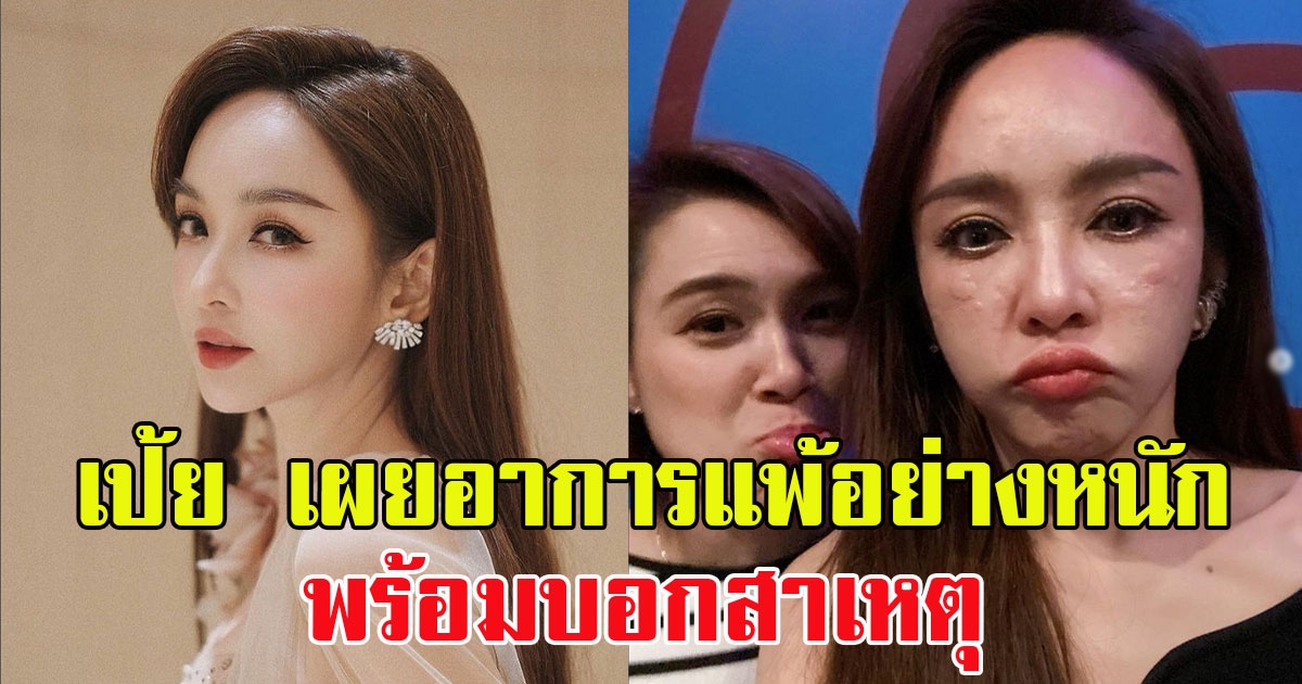 เป้ย ปานวาด เผยอาการแพ้อย่างหนัก พร้อมบอกสาเหตุ แฟนๆแห่เป็นห่วงเพียบ