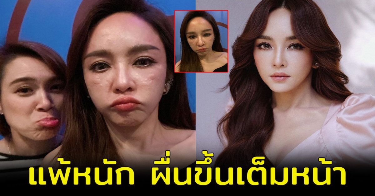 แฟนๆตกใจ เป้ย ปานวาด โพสต์ภาพ ผื่นขึ้นเต็มหน้า