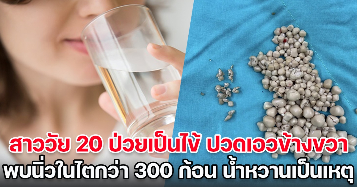 สาววัย 20 ป่วยเป็นไข้ ปวดเอวข้างขวา พบนิ่วในไตกว่า 300 ก้อน สาเหตุมาจากชอบดื่มน้ำชงน้ำหวาน (ข่าวต่างประเทศ)