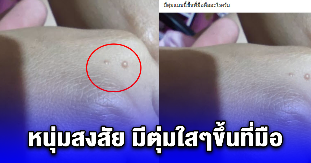 หนุ่มสงสัย มีตุ่มใสๆขึ้นที่มือ มันอันตรายมั๊ย