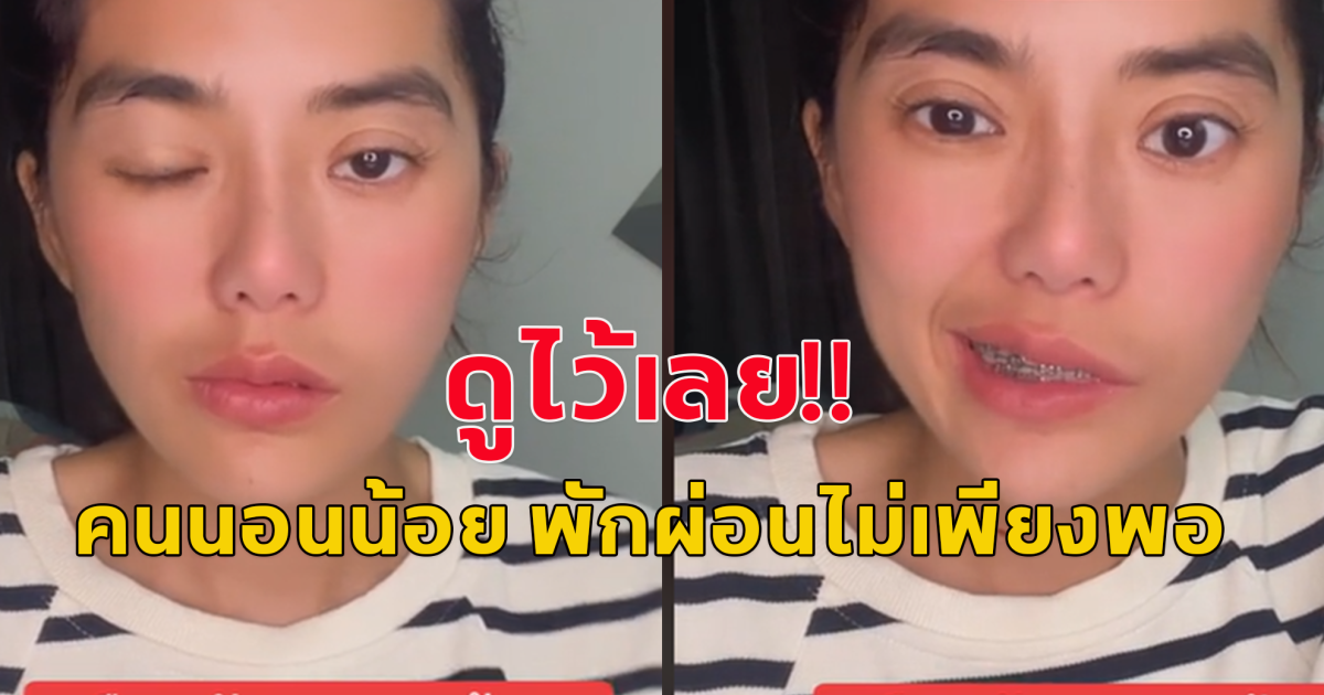 อุทาหรณ์ คนนอนน้อย พักผ่อนไม่เพียงพอ ตื่นขึ้นมา ใบหน้าใช้งานได้แค่ซีกเดียว