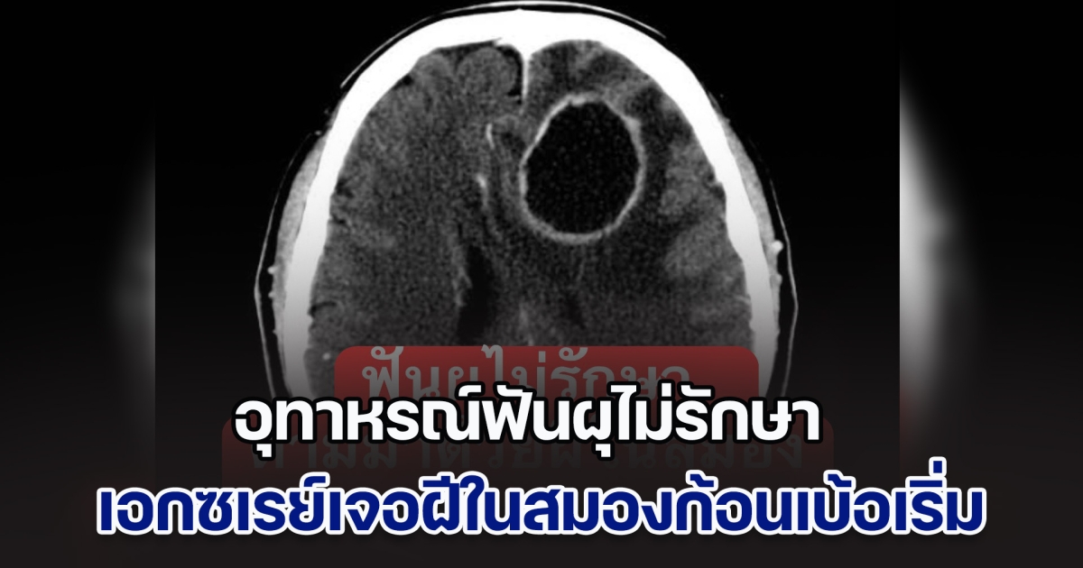 อุทาหรณ์ฟันผุไม่รักษา หมอสมองเผย เคสคนไข้อ่อนแรง คิดว่าเป็นสโตรก เอกซเรย์เจอฝีในสมองก้อนเบ้อเริ่ม