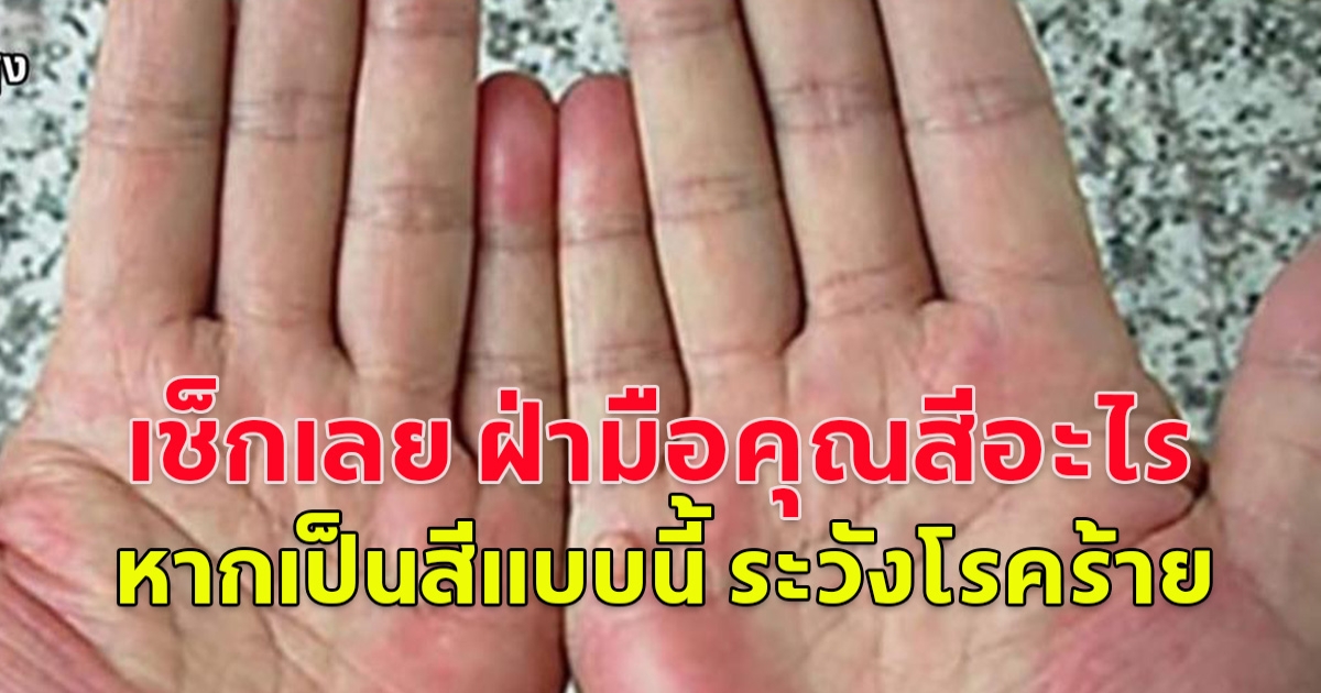 คุณมีฝ่ามือสีแบบไหน หมอเตือนหากเป็นสีแบบนี้ ระวังโรคร้าย
