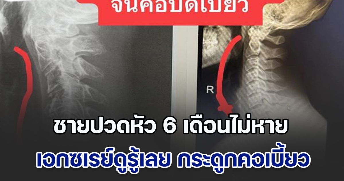 ต้องระวัง! ชายปวดหัว 6 เดือนไม่หาย เอกซเรย์ดูรู้เลย กระดูกคอเบี้ยว ชี้สาเหตุจากสิ่งที่หลายคนทำตลอด