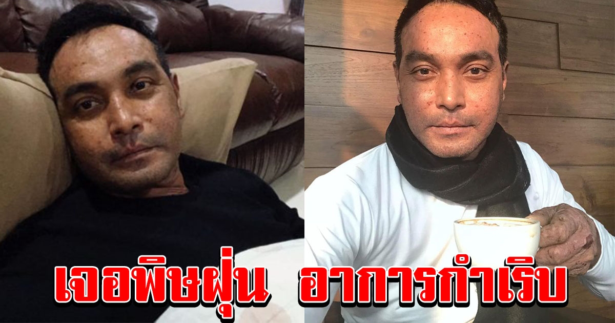 วินัย ไกรบุตร เตือนระวัง หลังเจอพิษฝุ่น ตุ่มกำเริบ