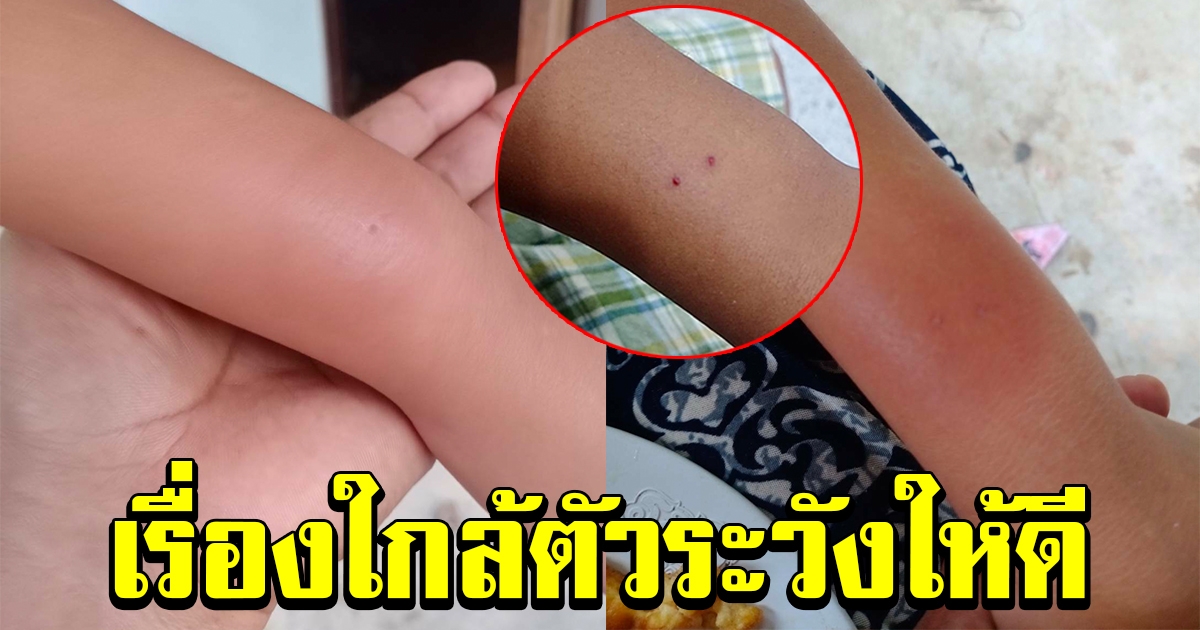 โผล่อีก แมงมุมพิษ ไม่ทราบชนิด กัดแขนเด็กหญิง 8 ขวบ