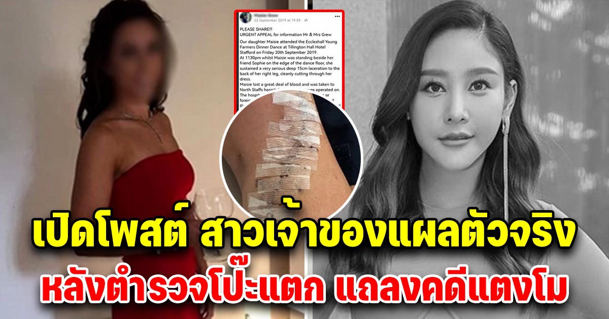 สาวเจ้าของแผลตัวจริง โพสต์แล้ว หลังตำรวจโป๊ะแตกใช้แถลงคดี แตงโม