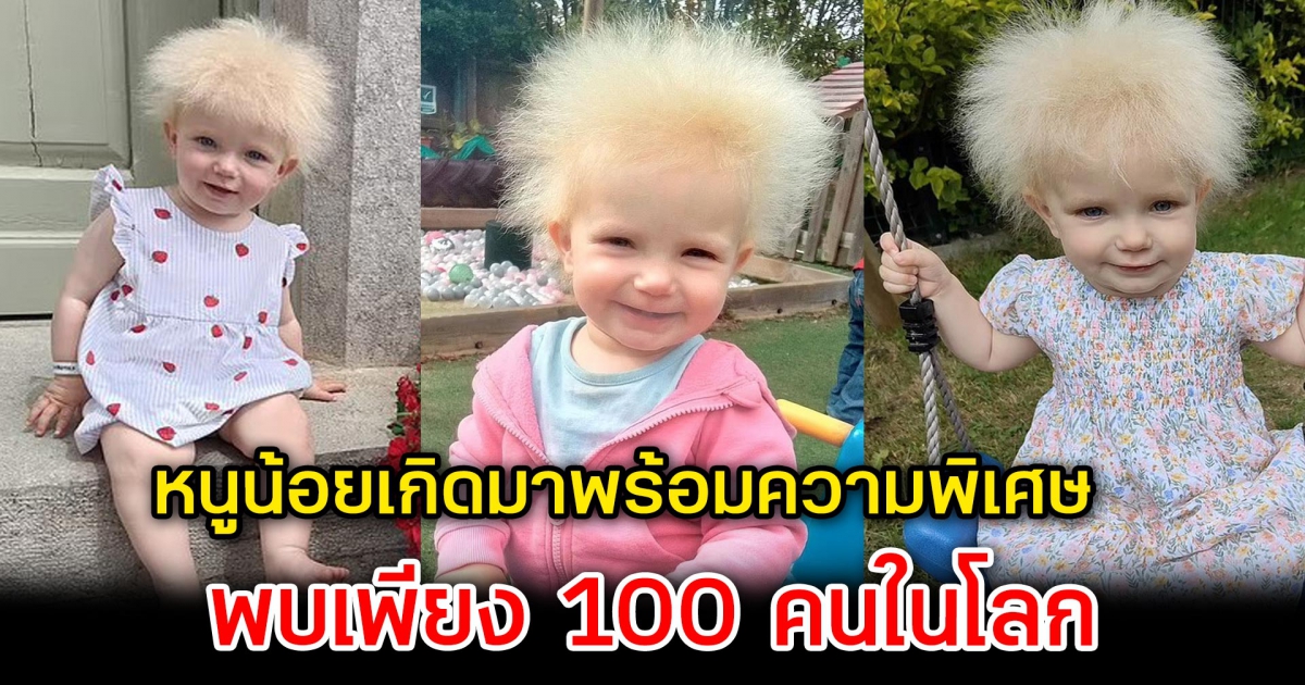 หนูน้อยเกิดมาพร้อมความพิเศษไม่เหมือนใคร พบเพียง 100 คนในโลก