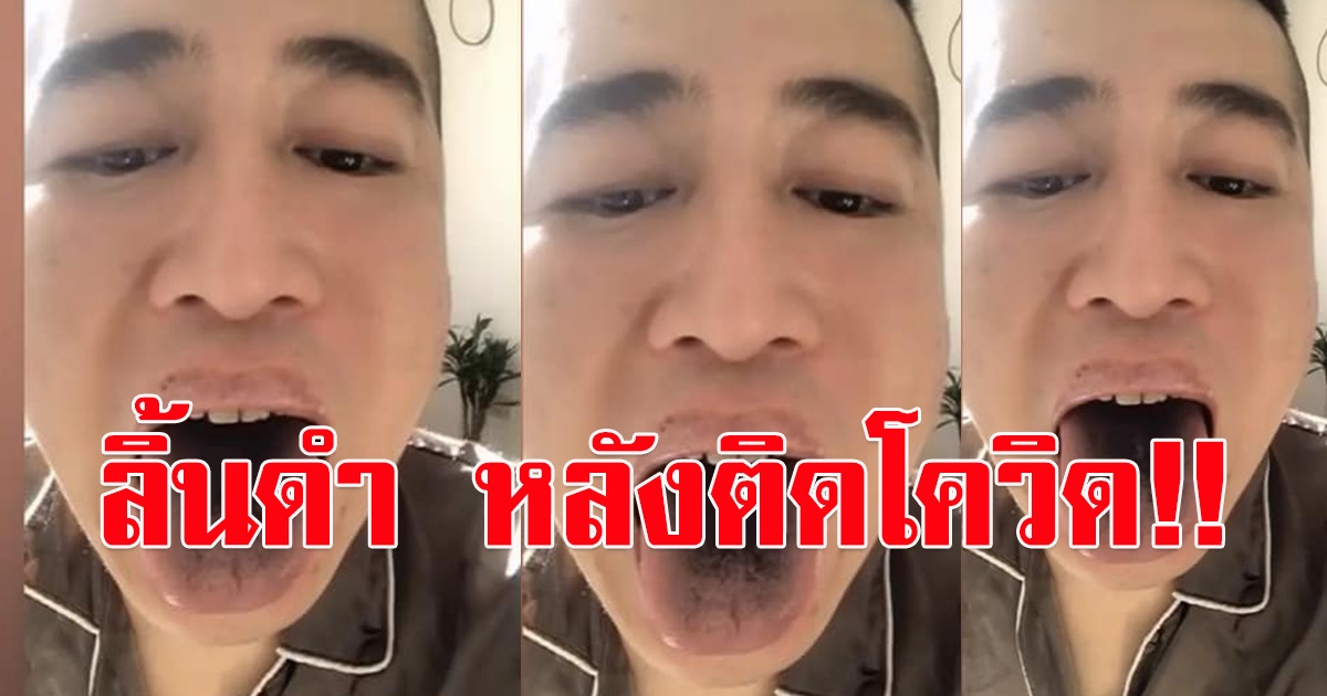 หนุ่มชาวจีน โชว์อาการ ลิ้นดำ หลัง CV19