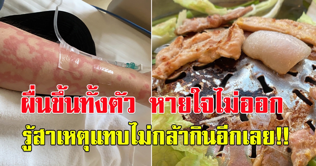 สาวโพสต์เตือน กินหมูกระทะ หายใจไม่ออก