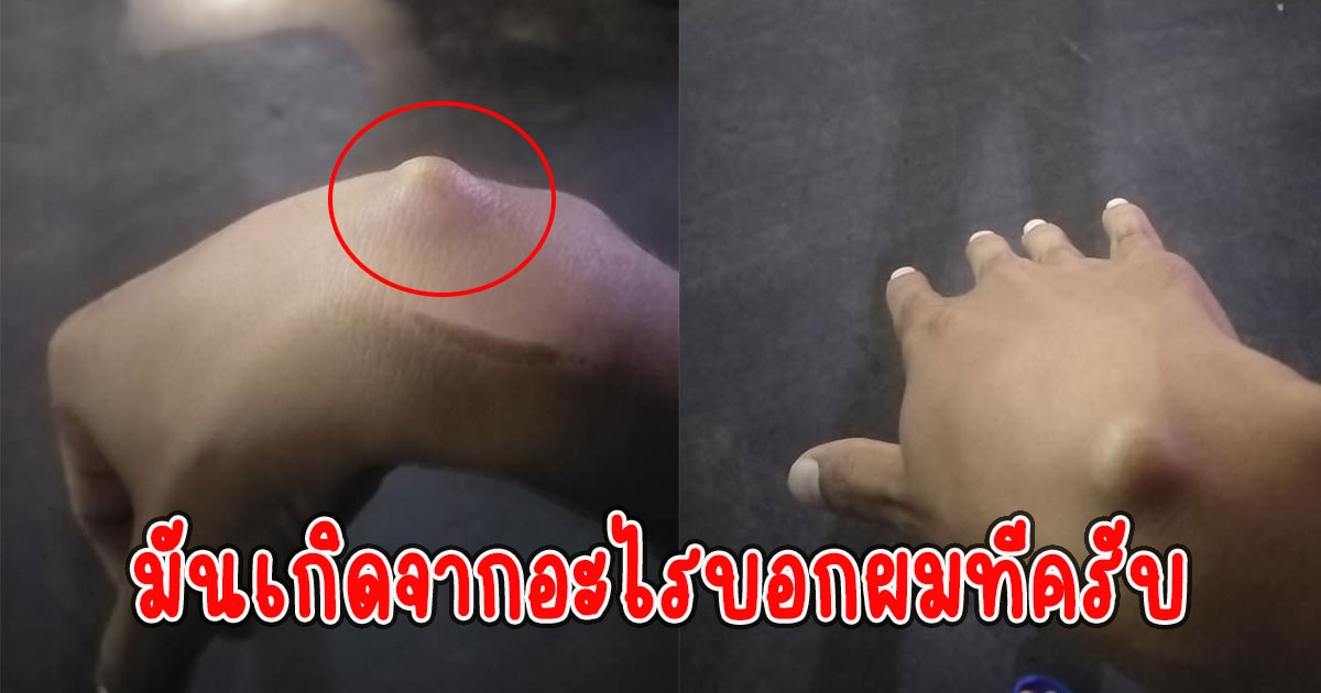 หนุ่มสงสัยรีบถามโซเชียล อยู่ๆข้อมือมีตุ่มขึ้น จับแล้วไม่ค่อยเจ็บ