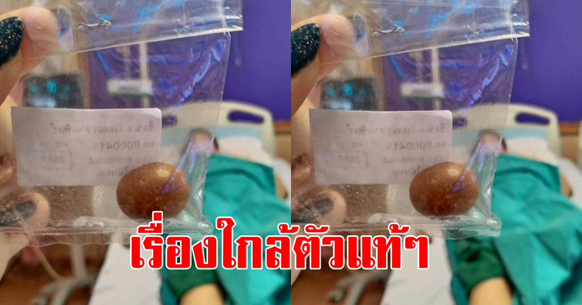 สาวต้องผ่าตัด นิ่วในถุงน้ำดี พร้อมโพสต์เตือนภัย รู้สาเหตุ ระวังกันให้มาก