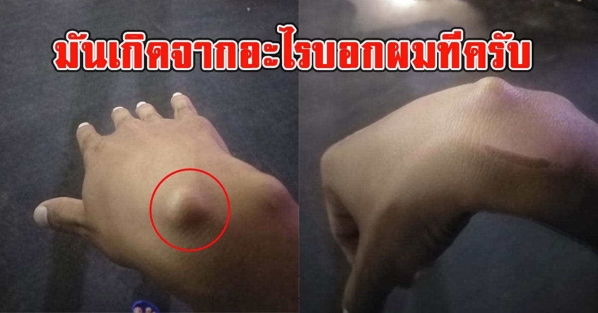 หนุ่มสงสัยรีบถามโซเชียล อยู่ๆข้อมือมีตุ่มขึ้น จับแล้วไม่ค่อยเจ็บ