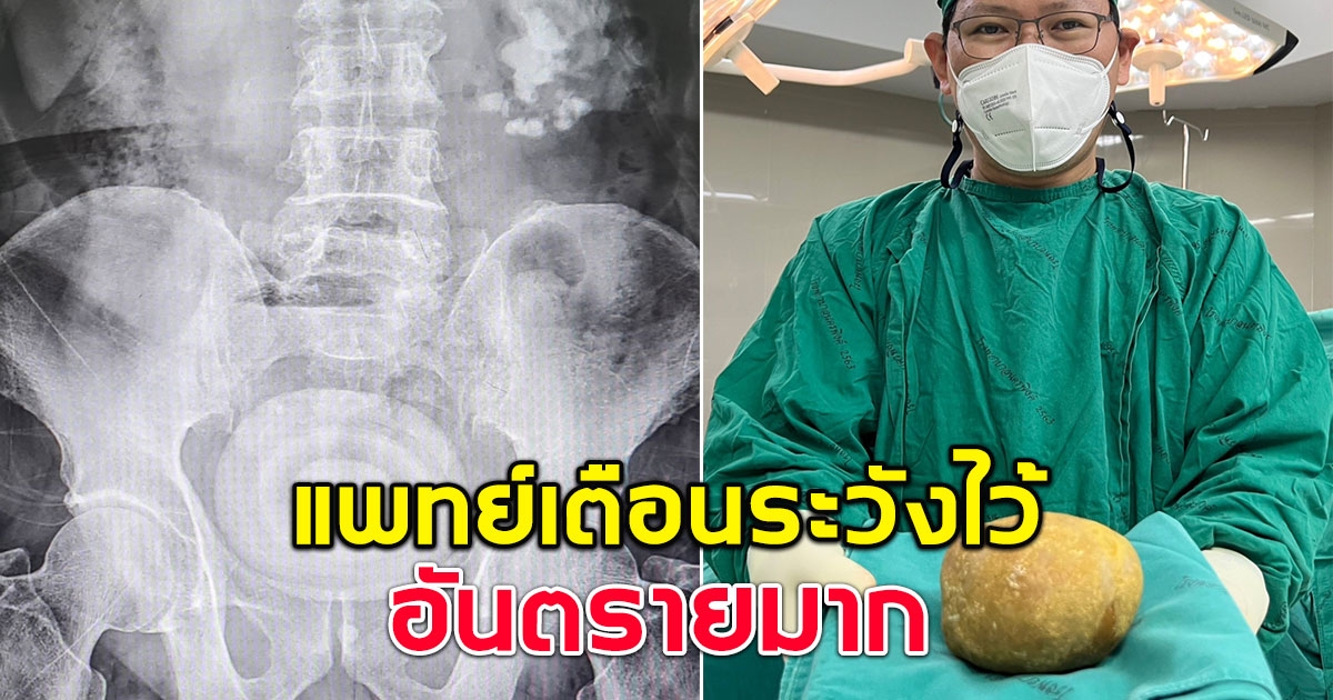 ชายวัย 74 ปวดท้องหนัก สุดท้ายตรวจเจอก้อนแข็ง แพทย์เตือนดูไว้อันตรายมาก
