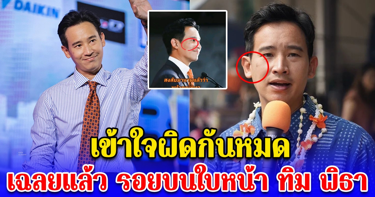 เข้าใจผิดกันหมด เฉลยแล้ว รอยบนใบหน้า ทิม พิธา