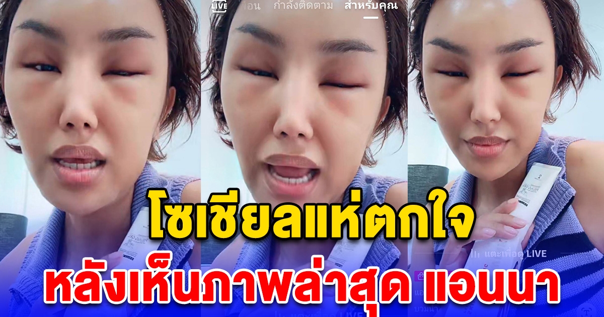 ภาพล่าสุดแอนนา ทำเอาโซเชียลตกใจ แห่เป็นห่วง