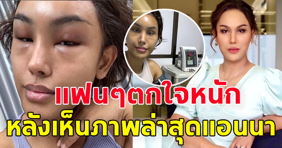 แฟนๆตกใจหนัก แห่เป็นห่วง หลังเห็นภาพล่าสุด แอนนา