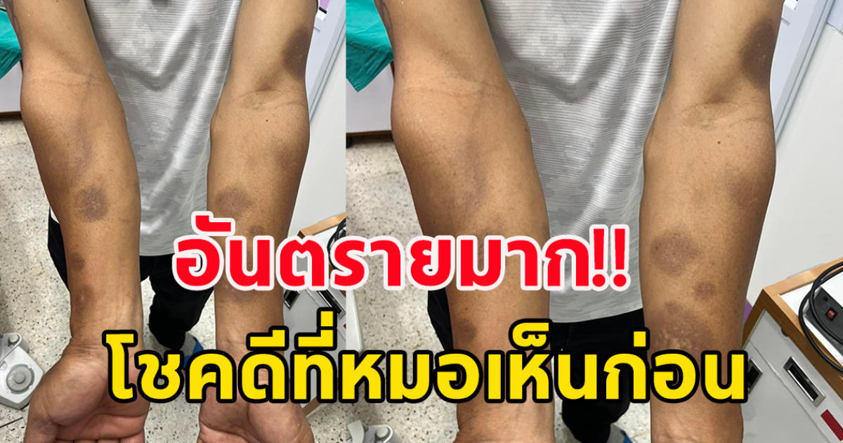 คนไข้มาถอนฟัน หมอสังเกตเห็นรอยบนตัว โชคดีที่เห็นก่อน