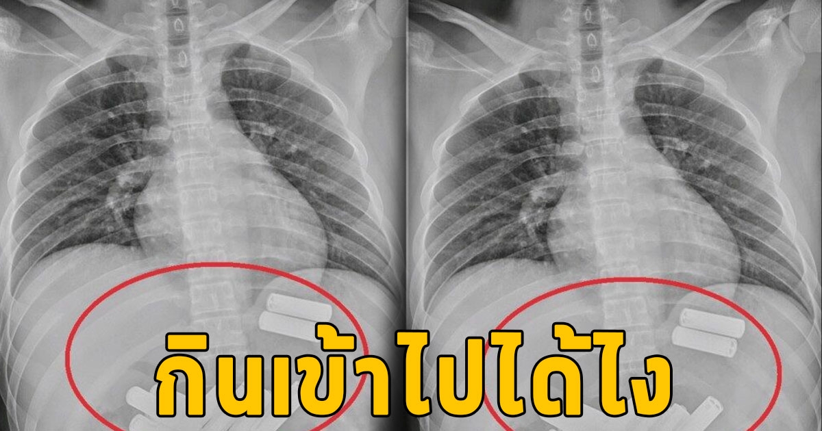 หนุ่มวัย 23 ปี ปวดท้องกะทันหัน รุดเข้าห้องฉุกเฉินกลางดึก เอกซเรย์ดูถึงเจอสาเหตุกินเข้าไปได้ไง