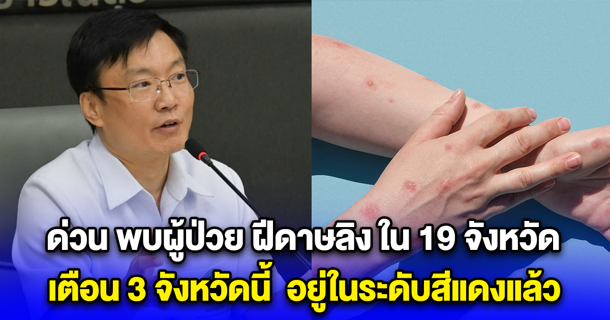 ด่วน พบผู้ป่วย ฝีดาษลิง ใน 19 จังหวัด เตือน 3 จังหวัดนี้ อยู่ในระดับสีแดงแล้ว