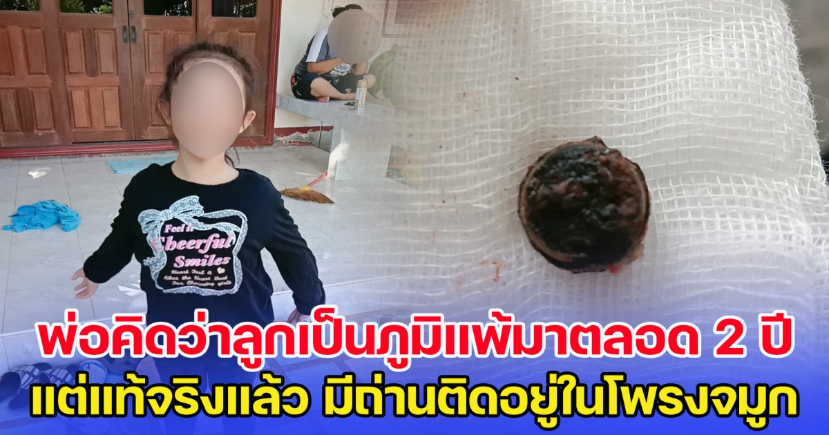 พ่อคิดว่าลูกเป็นภูมิแพ้มาตลอด 2 ปี แต่แท้จริงแล้ว มีถ่านติดอยู่ในโพรงจมูก