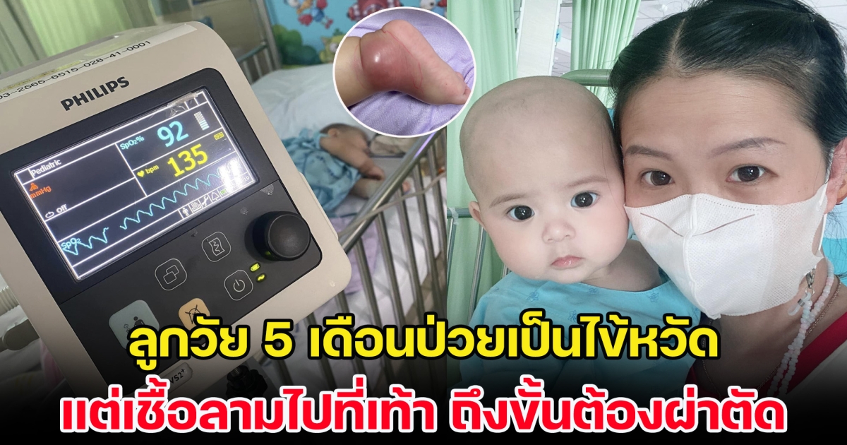 แม่แชร์อุทาหรณ์ ลูกวัย 5 เดือนป่วยเป็นไข้หวัด แต่เชื้อลามไปที่เท้า ถึงขั้นต้องผ่าตัด