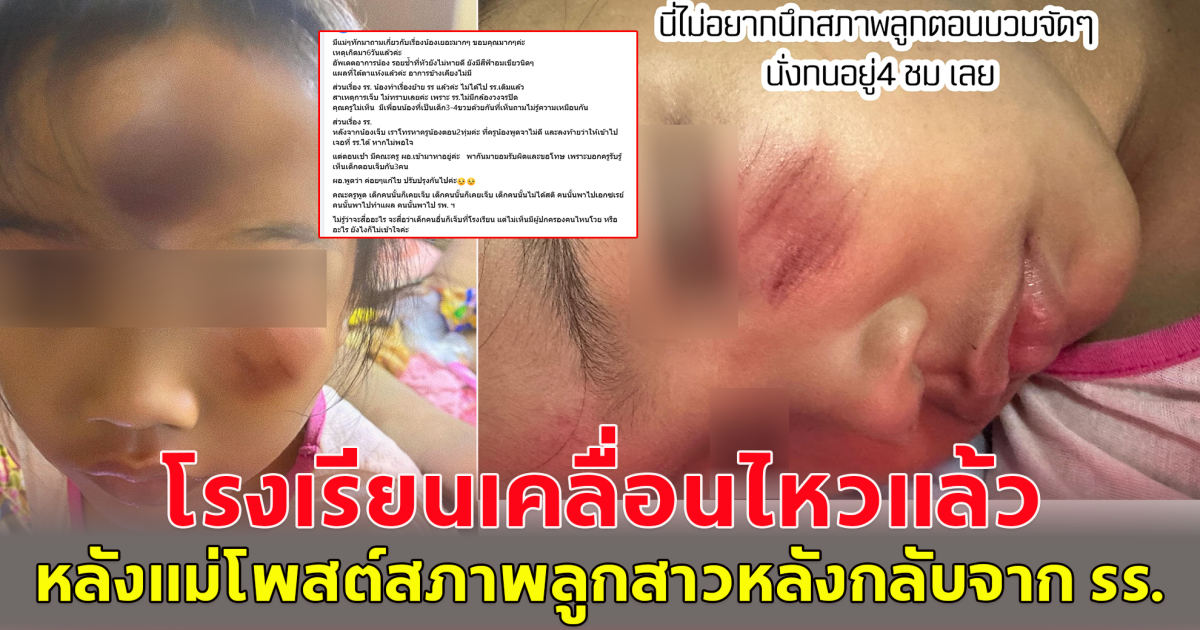 โรงเรียนเคลื่อนไหวแล้ว หลังแม่โพสต์ ลูกสาววัย 4 ขวบ กลับจากโรงเรียน หัวปูด-ตาปิด