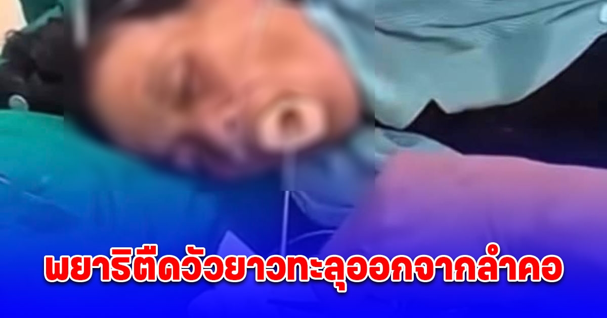 อุทาหรณ์สายซอยจุ๊ กินดิบ พยาธิตืดวัวยาวทะลุออกจากลำคอ