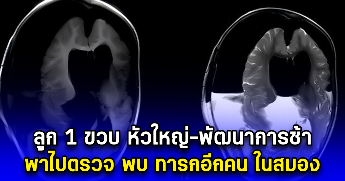 ลูก 1 ขวบ หัวใหญ่-พัฒนาการช้า พาไปตรวจ พบ ทารกอีกคน ในสมอง (ตปท.)