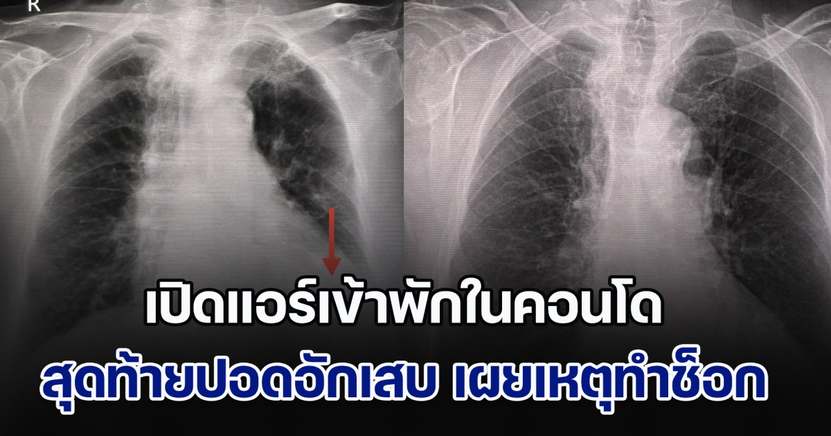 หมอเผยเคส เปิดแอร์เข้าพักในคอนโด สุดท้ายปอดอักเสบ พอไล่หาสาเหตุถึงได้รู้ หลายคนต้องระวัง