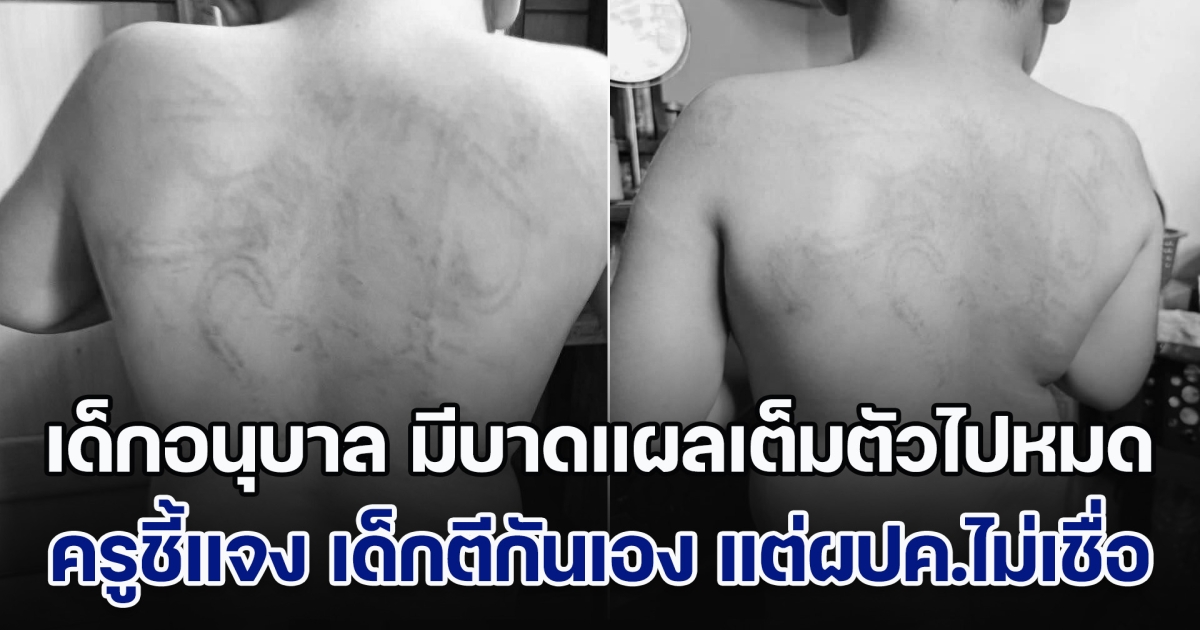 ถกสนั่น! เด็กอนุบาล มีบาดแผลเต็มตัวไปหมด ครูชี้แจง บอกเด็กตีกันเอง แต่ผปค.ทั้ง 2 ฝ่ายติดใจ ไม่อยากเชื่อ