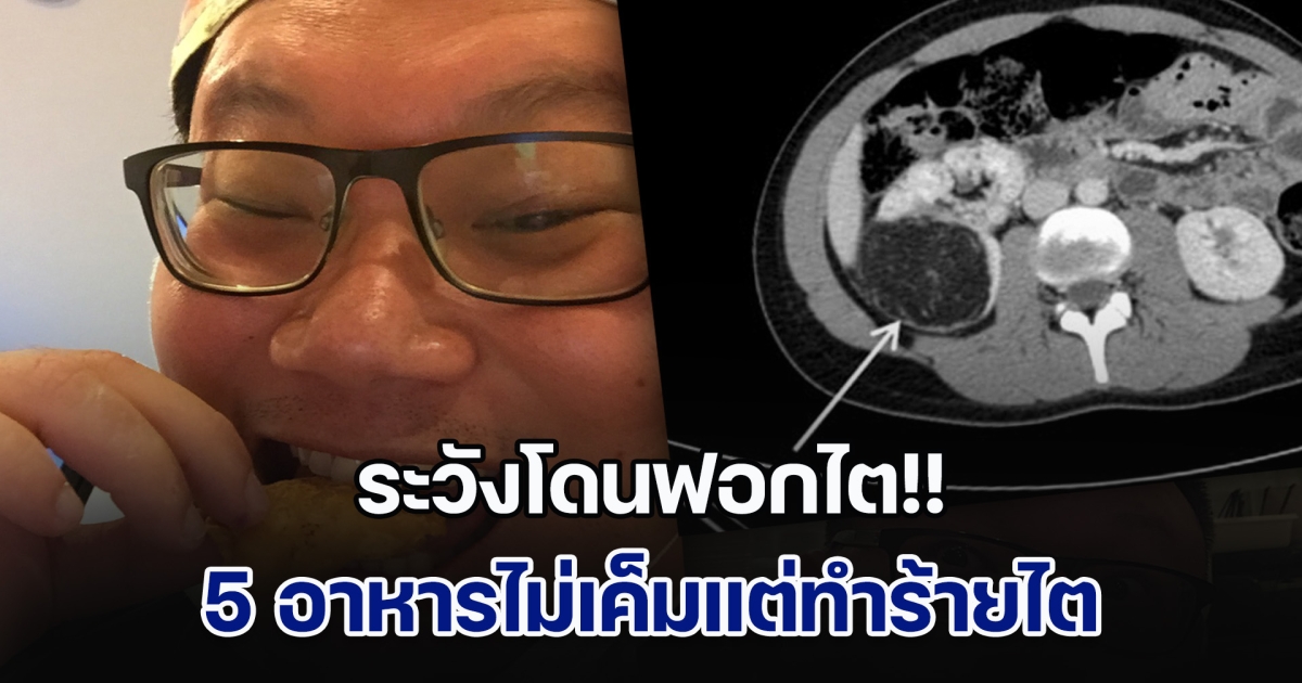 คุณหมอเตือนด่วน ระวังโดนฟอกไต เผย 5 อาหารไม่เค็มแต่ทำร้ายไต