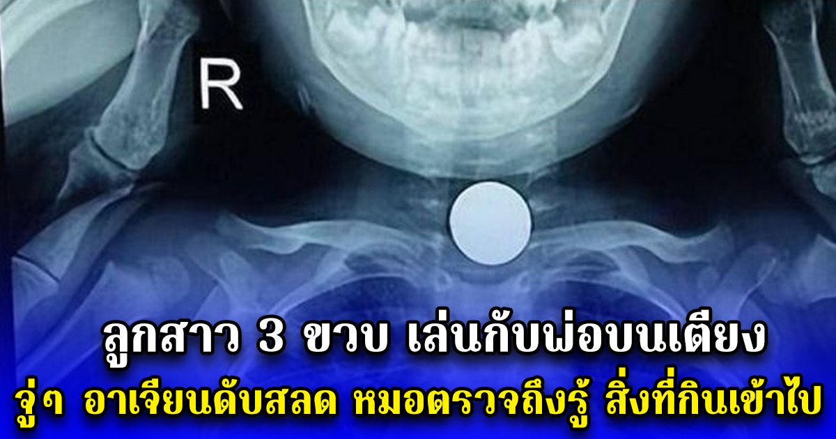 ลูกสาว 3 ขวบ เล่นกับพ่อบนเตียง จู่ๆ อาเจียนดับสลด หมอตรวจถึงรู้ สิ่งที่กินเข้าไป