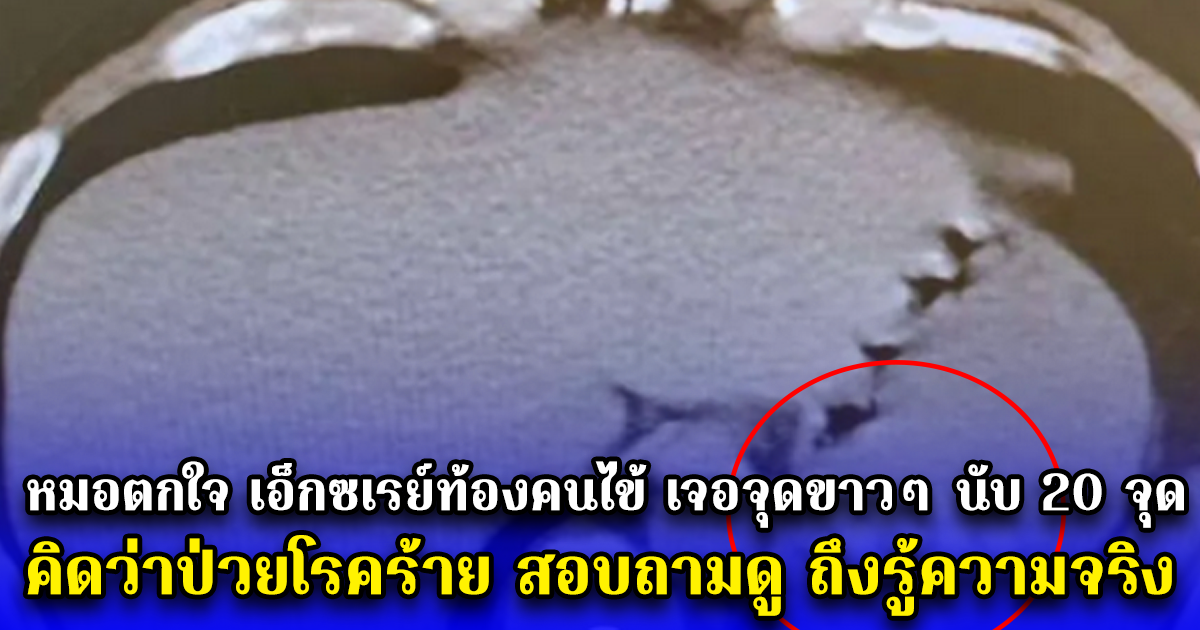 หมอตกใจ เอ็กซเรย์ท้องคนไข้ เจอจุดขาวๆ นับ 20 จุด คิดว่าป่วยโรคร้าย สอบถามดู ถึงรู้ความจริง (ตปท.)