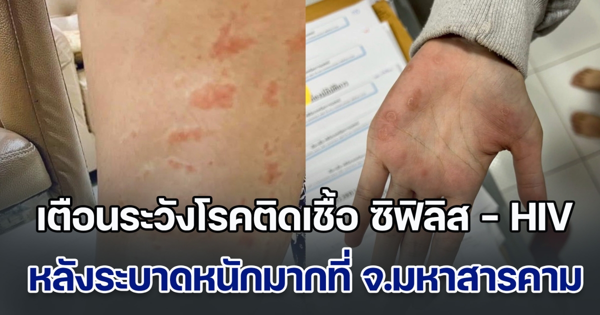 เตือนระวังโรคติดเชื้อ ซิฟิลิส - HIV หลังระบาดหนักมากที่ จ.มหาสารคาม พุ่งสูงแตะเกือบ 500 คน