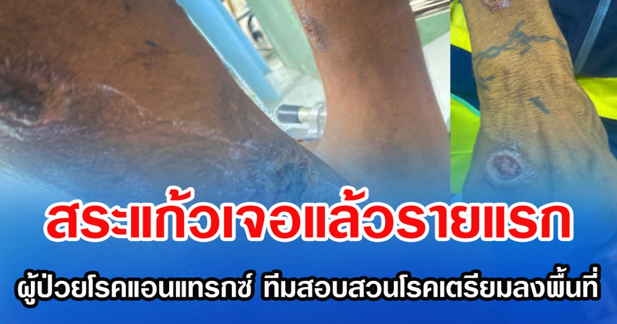 สระแก้วเจอแล้วรายแรก ผู้ป่วยโรคแอนแทรกซ์ ทีมสอบสวนโรคเตรียมลงพื้นที่