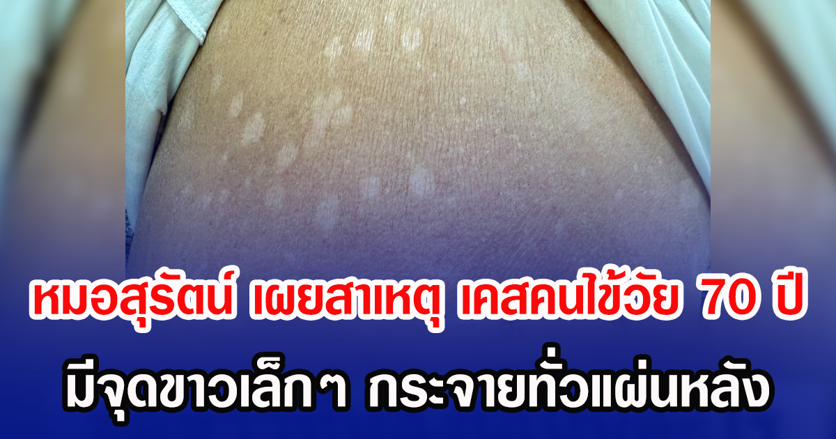 หมอสุรัตน์ เผยสาเหตุ เคสคนไข้วัย 70 ปี มีจุดขาวเล็กๆ กระจายทั่วแผ่นหลัง