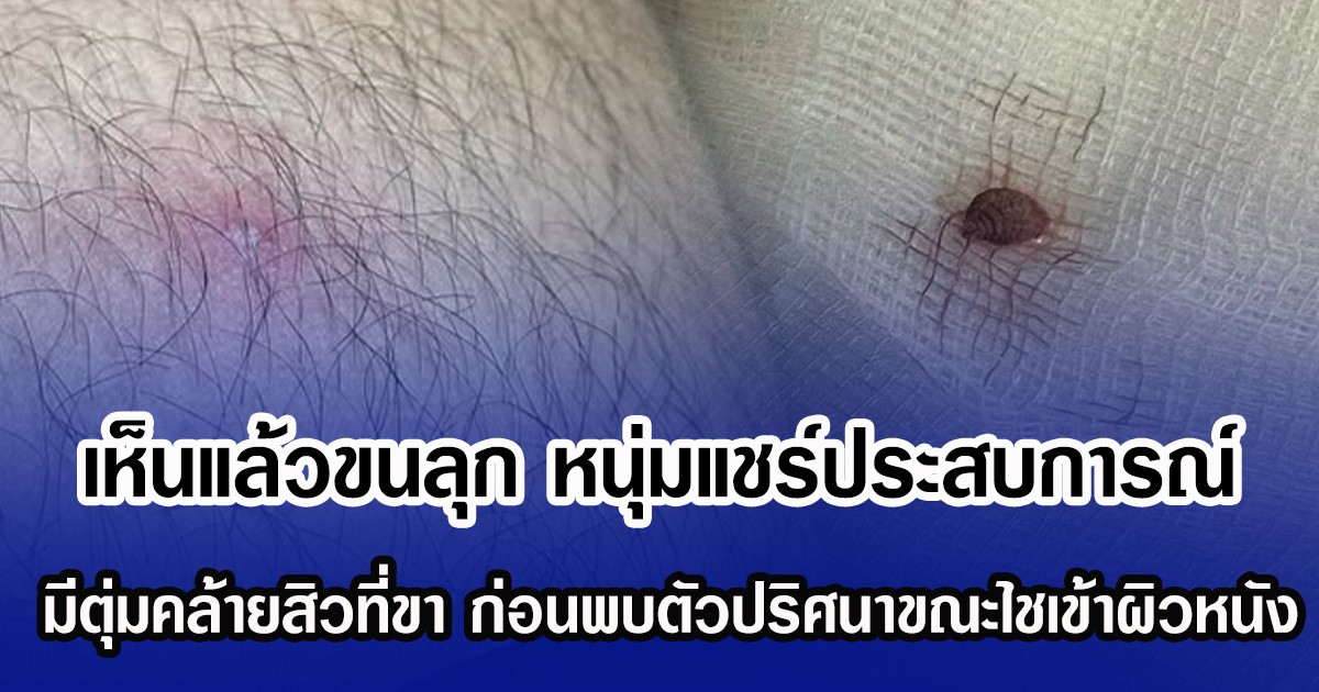 เห็นแล้วขนลุก หนุ่มแชร์ประสบการณ์ มีตุ่มคล้ายสิวที่ขา ก่อนพบตัวปริศนาขณะไชเข้าผิวหนัง