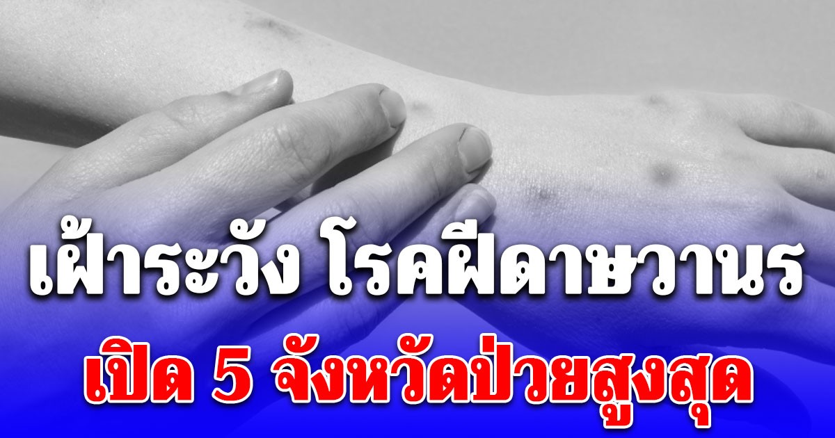 เปิด 5 จังหวัดน่ากังวล ยอดผู้ป่วยติด โรคฝีดาษวานร