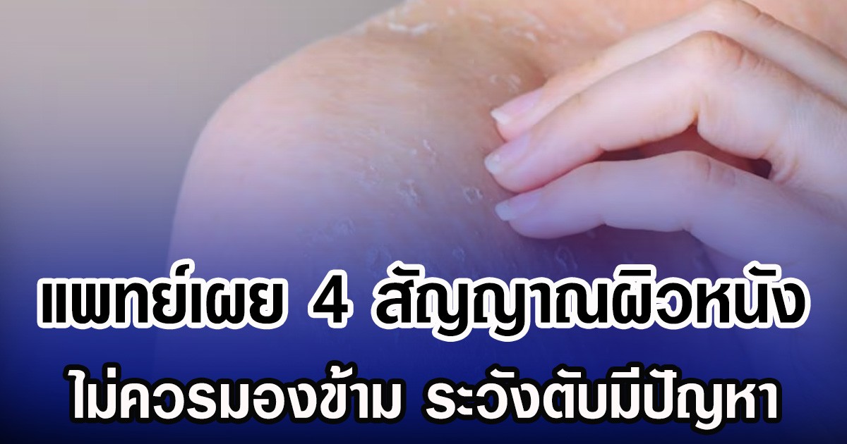 แพทย์เผย 4 สัญญาณผิวหนัง ไม่ควรมองข้าม ระวังตับมีปัญหา
