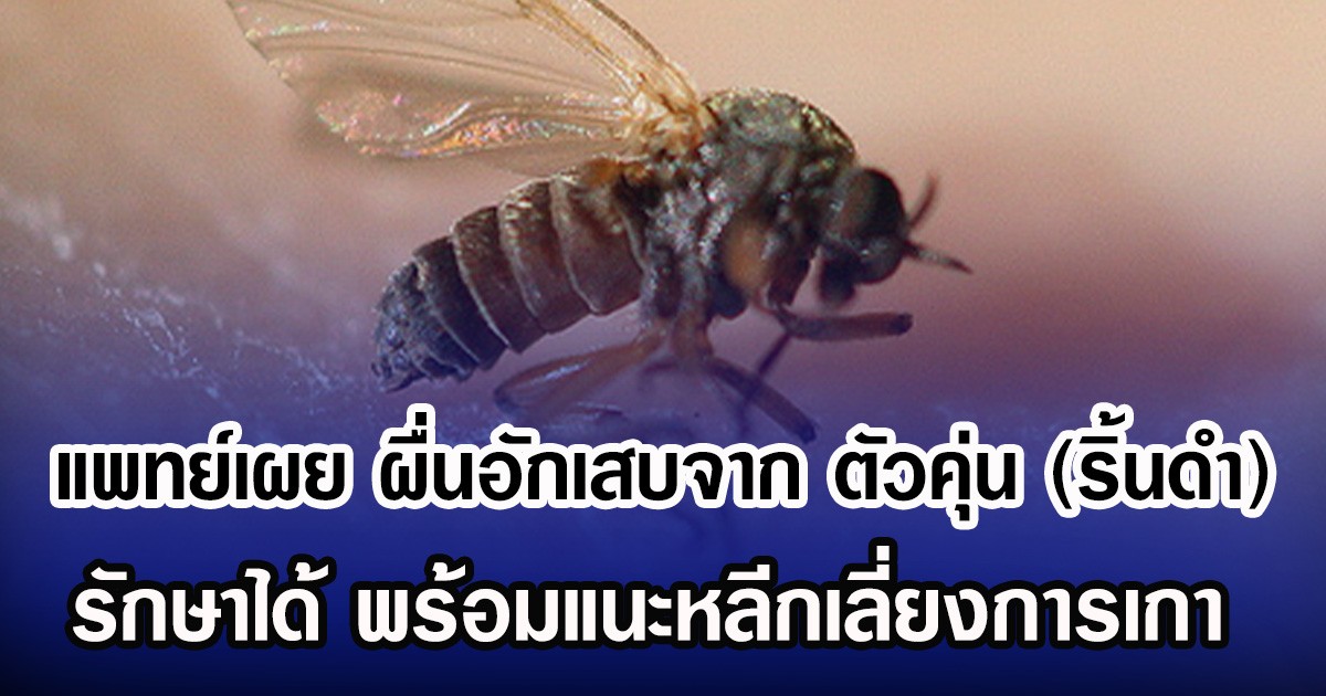 แพทย์เผย ผื่นอักเสบจาก ตัวคุ่น (ริ้นดำ) รักษาได้ พร้อมแนะหลีกเลี่ยงการเกา