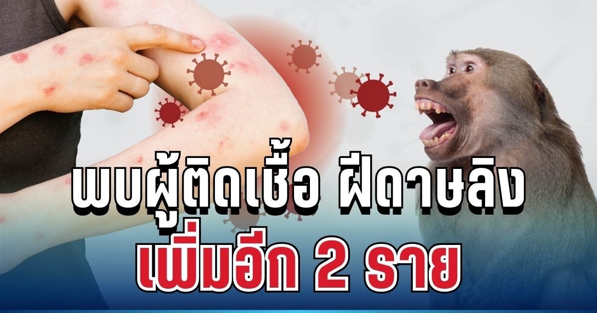 ด่วน! พบผู้ติดเชื้อ ฝีดาษลิง เพิ่มอีก 2 ราย เปิดอาการล่าสุด