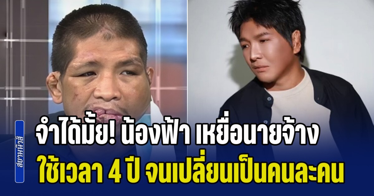 จำได้มั้ย! น้องฟ้า เหยื่อนายจ้างทารุณ 15 ปี จนใบหน้ายับเยิน แต่ฟ้าหลังฝน ใช้เวลา 4 ปี รักษาจนเปลี่ยนเป็นคนละคน จำแทบไม่ได้